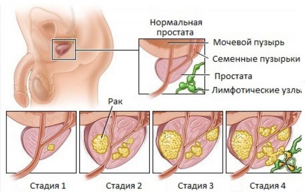 Простата в норме и стадии рака предстательной железы