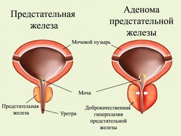 Здоровая простата и простата при аденоме